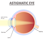 Astigmatism