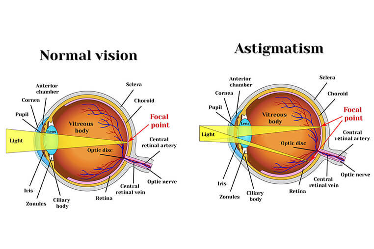 astigmatism