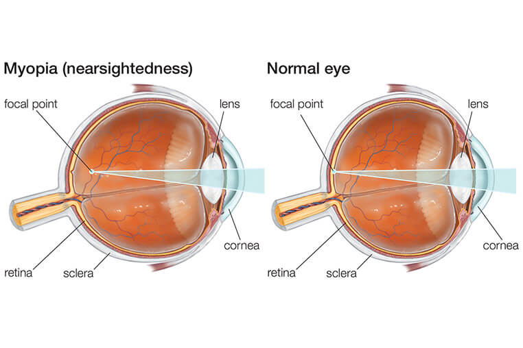Miopia, cum se trateaza. Cabinet oftamologic cluj