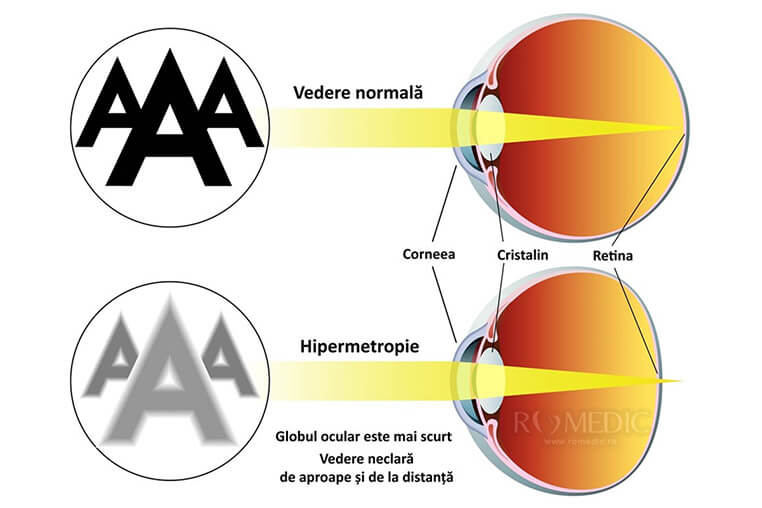 Hipermetropia