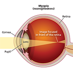 Miopia