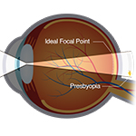 Presbiopia